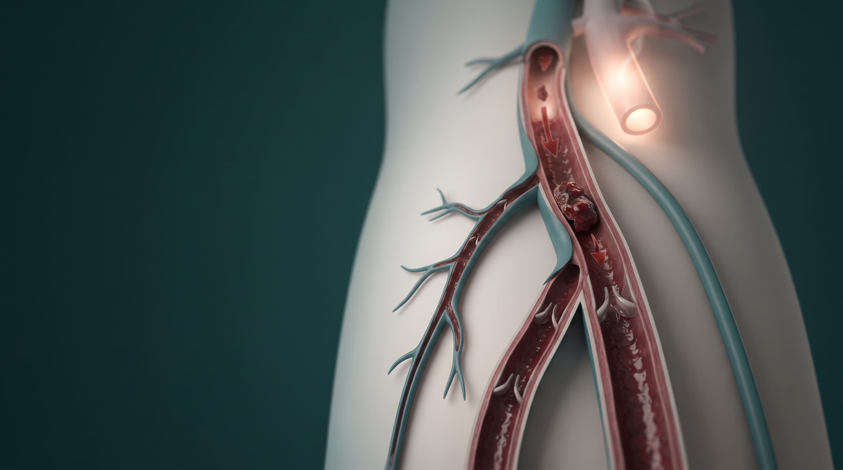 Can a blood clot break off: what really happens